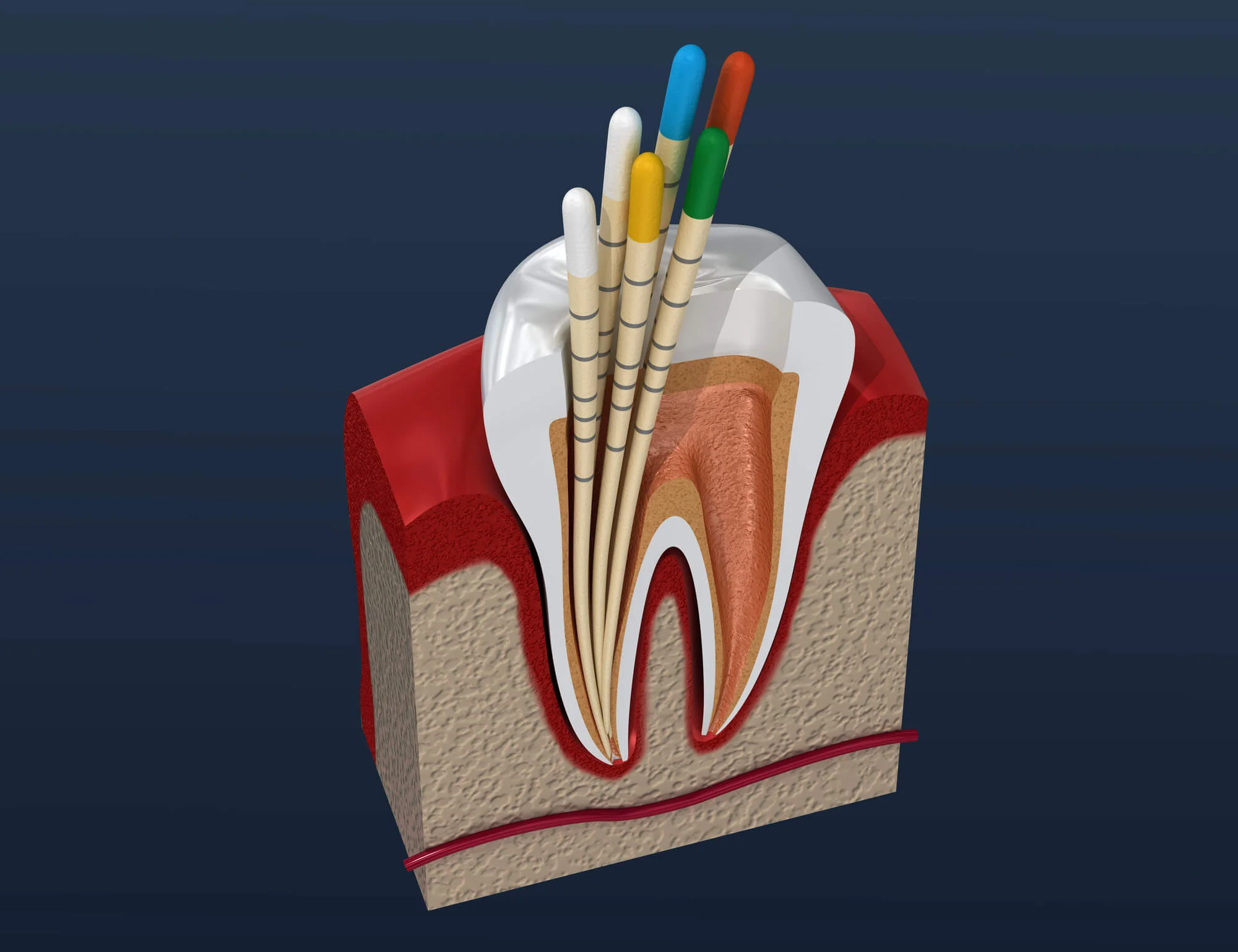 Root-canal-in-North-Charleston-SC-procedure-diagram