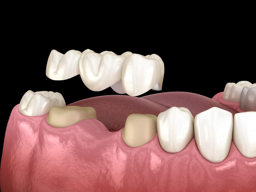 bridge-dental-charleston-sc-3d-illustration-of-a-dental-bridge-being-placed-over-two-abutment-teeth