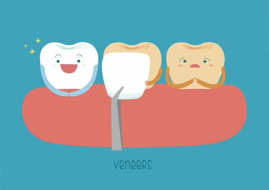 veneers-charleston-sc-cartoon-illustration-of-a-veneer-being-placed-on-a-stained-tooth
