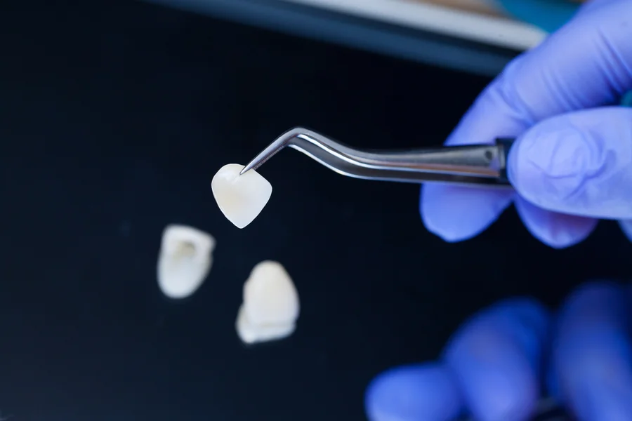veneers-charleston-sc-dentist-holding-a-porcelain-veneer-with-tweezers